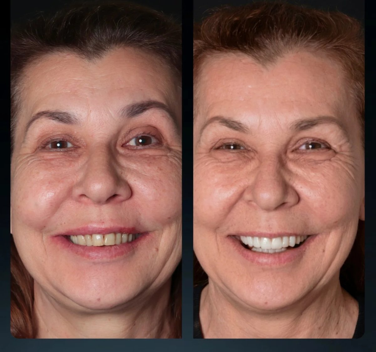Resultados antes y después de smile makeover: mejor color y alineación dental