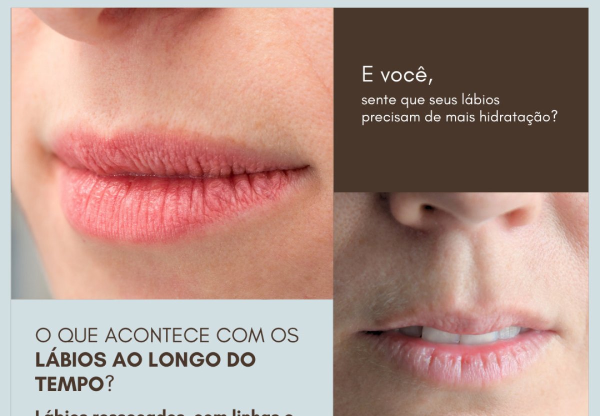 Before and after Skinbooster for lips hydration, visible improvement in lip smoothness result