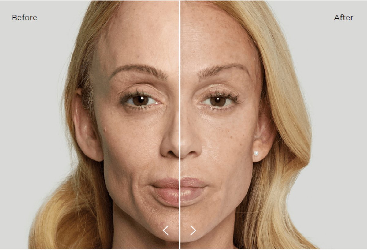 Resultado antes y después de inyecciones de relleno: rostro más suave y rejuvenecido