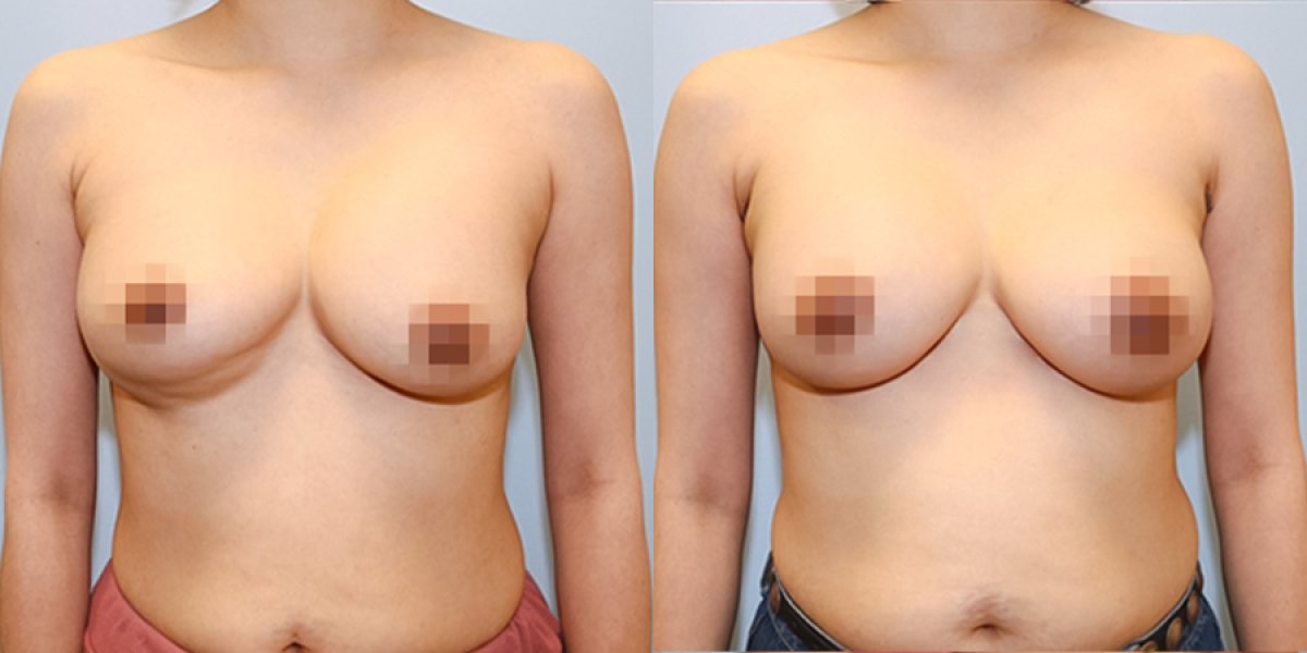 Before and after breast lift results – improved breast shape and symmetry after procedure