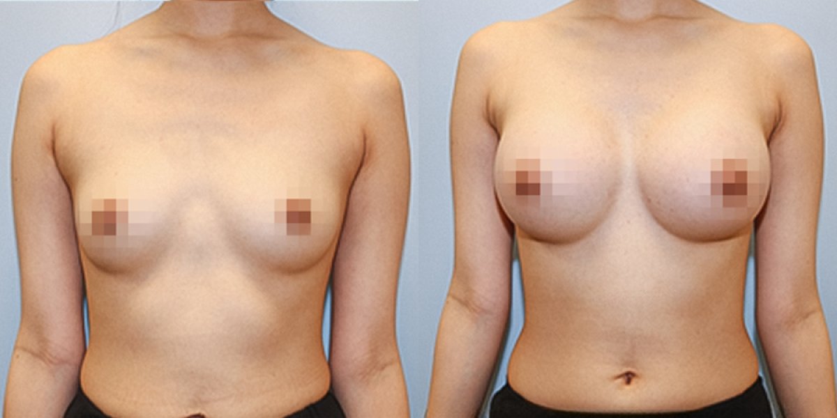 Before and after breast augmentation results – enhanced breast size and contour improvement