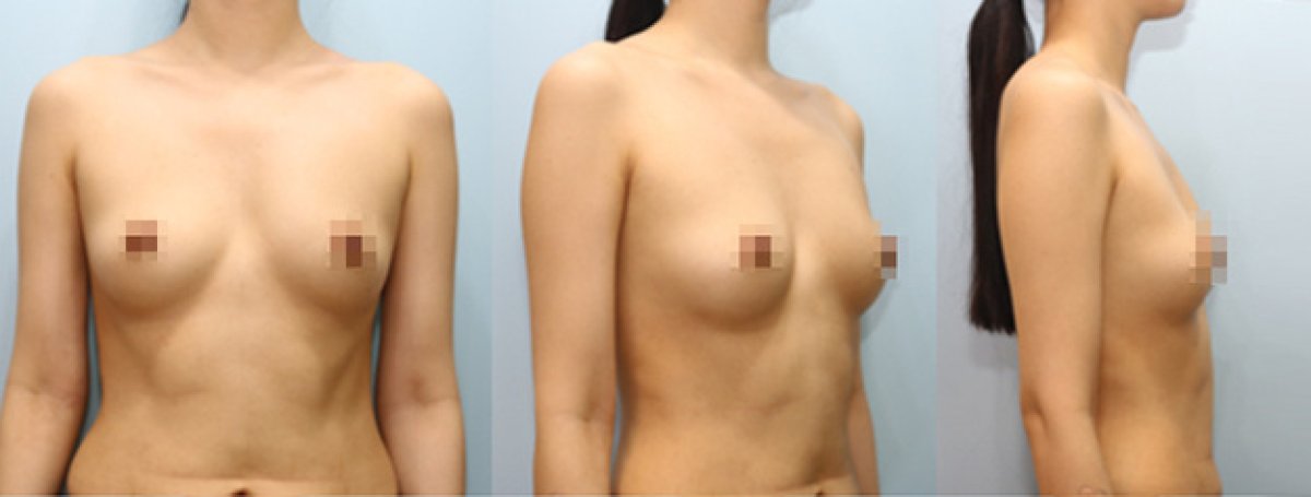 Breast augmentation before and after results – enhanced breast volume and contour
