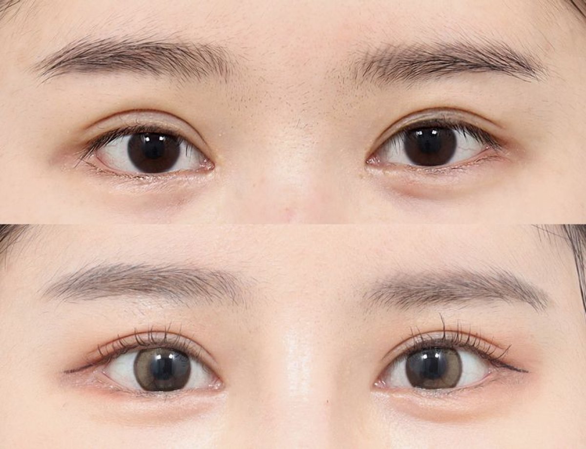 نتائج عملية الجفن العلوي في AB Plastic Surgery، مظهر عيون أكثر إشراقًا