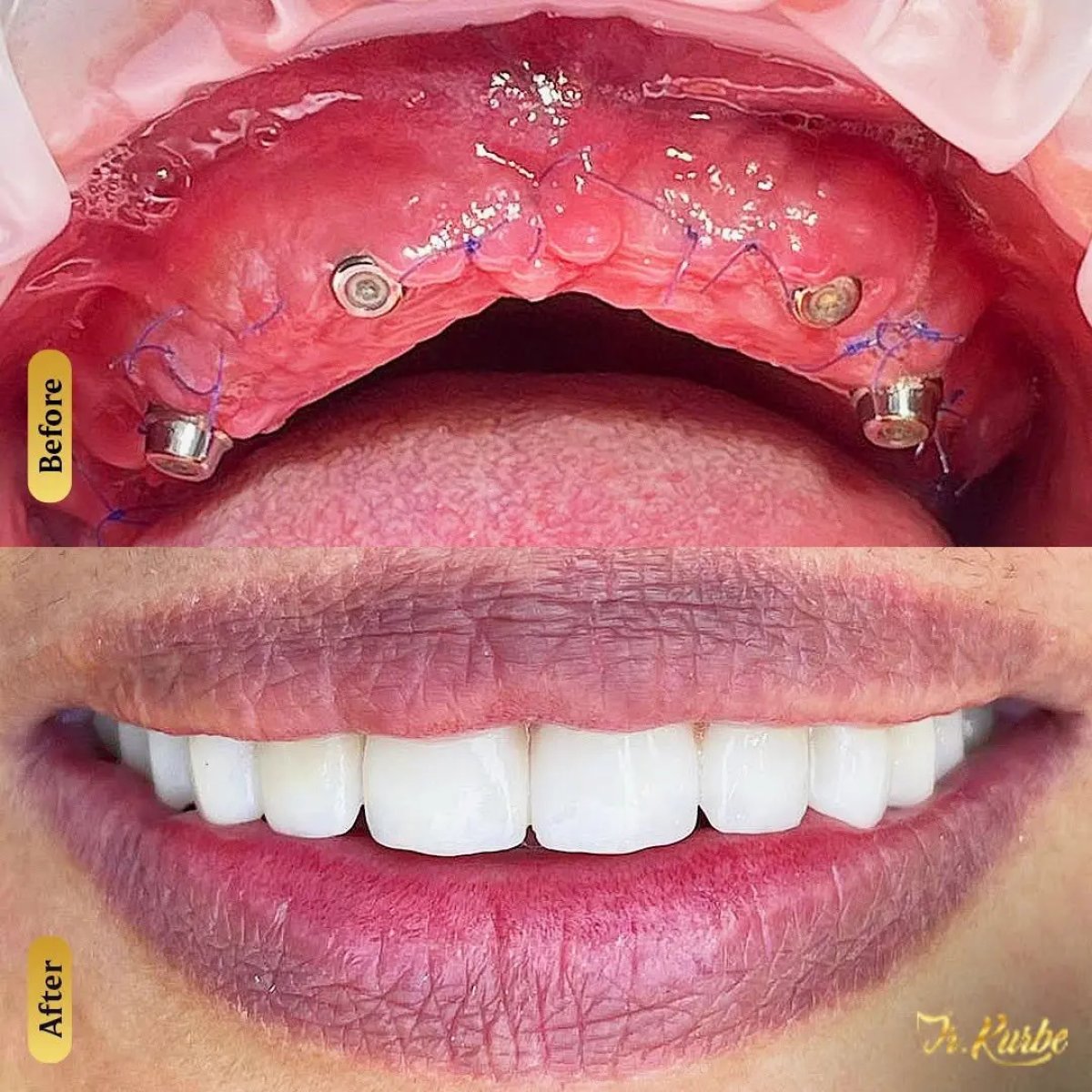 Before and after Hybrid All-on-4 implant denture results – full smile restoration