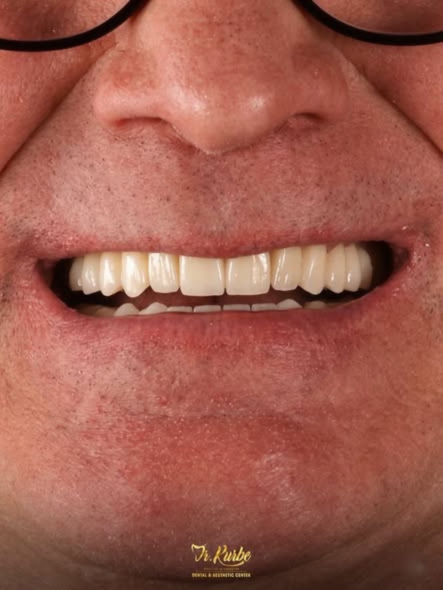 Resultado de implante dental con corona en Dr. Kurbe Dental & Aesthetic Center, sonrisa mejorada