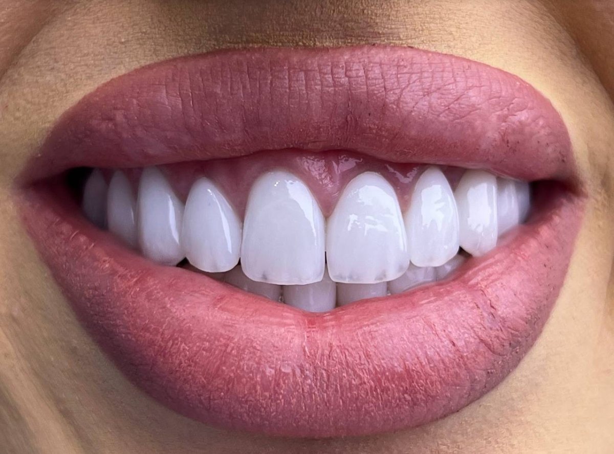 Результат Hollywood Smile с винирами – белые ровные зубы после косметической стоматологии