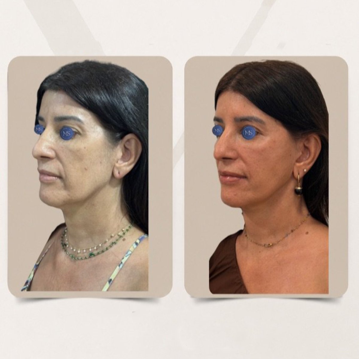 Before and after blepharoplasty results at Dr. Michel Salameh - Plastic And Aesthetic Surgery
