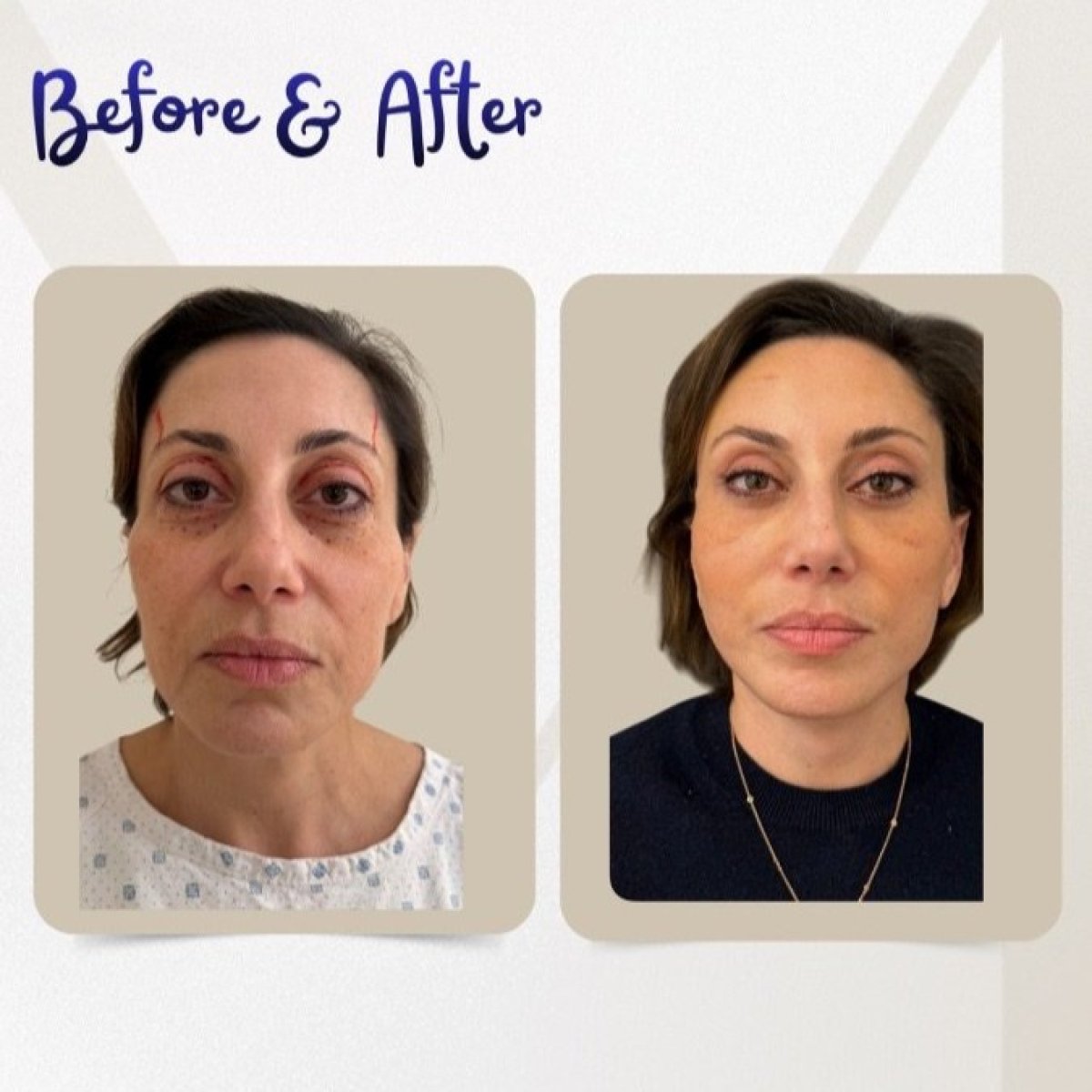 Before and after blepharoplasty results at Dr. Michel Salameh - Plastic And Aesthetic Surgery