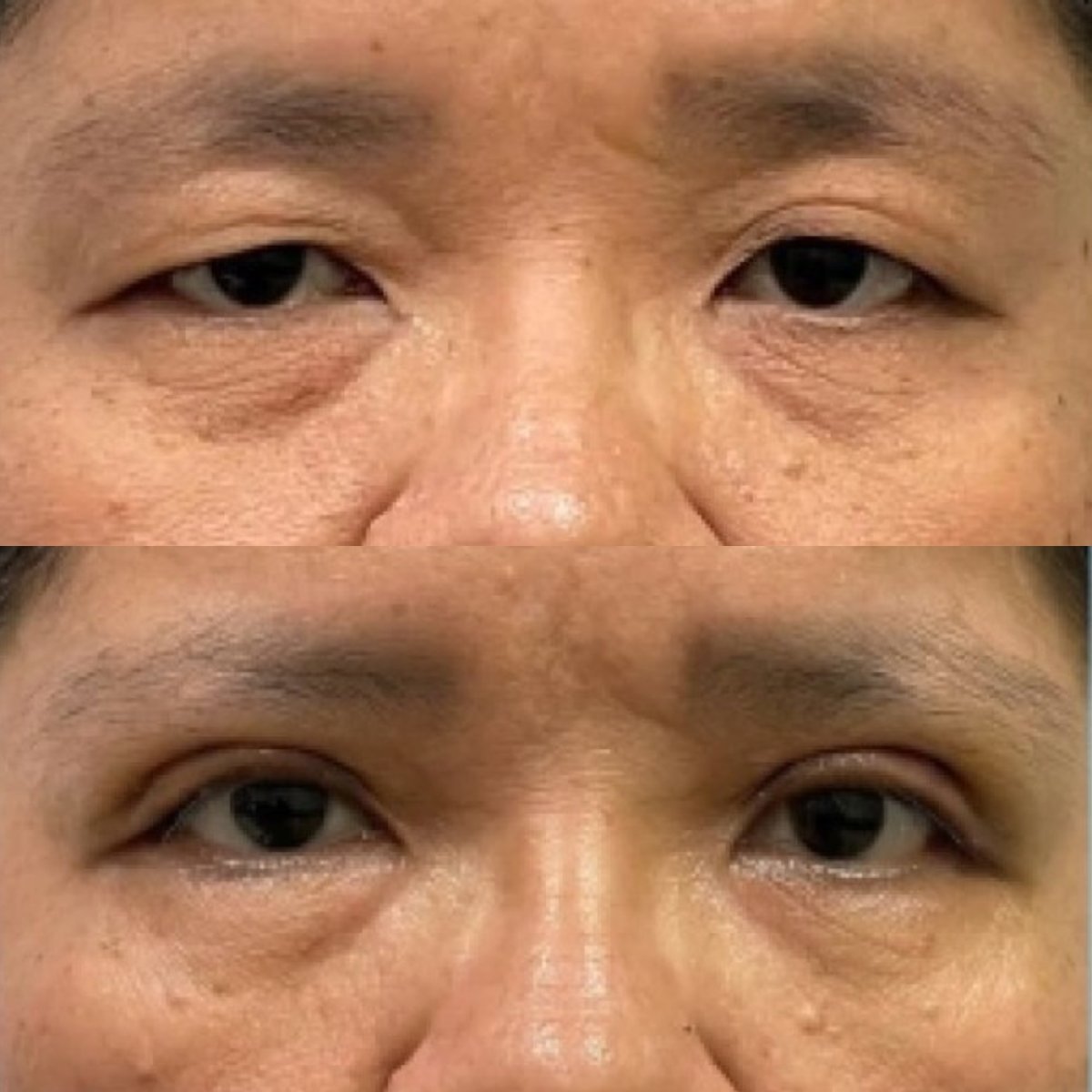 Before and after blepharoplasty results, eyelid correction with reduced puffiness