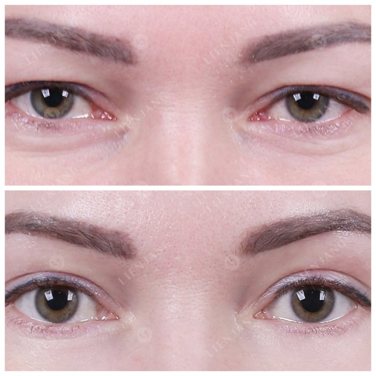Resultados de blefaroplastia antes y después, corrección de párpados con mirada rejuvenecida