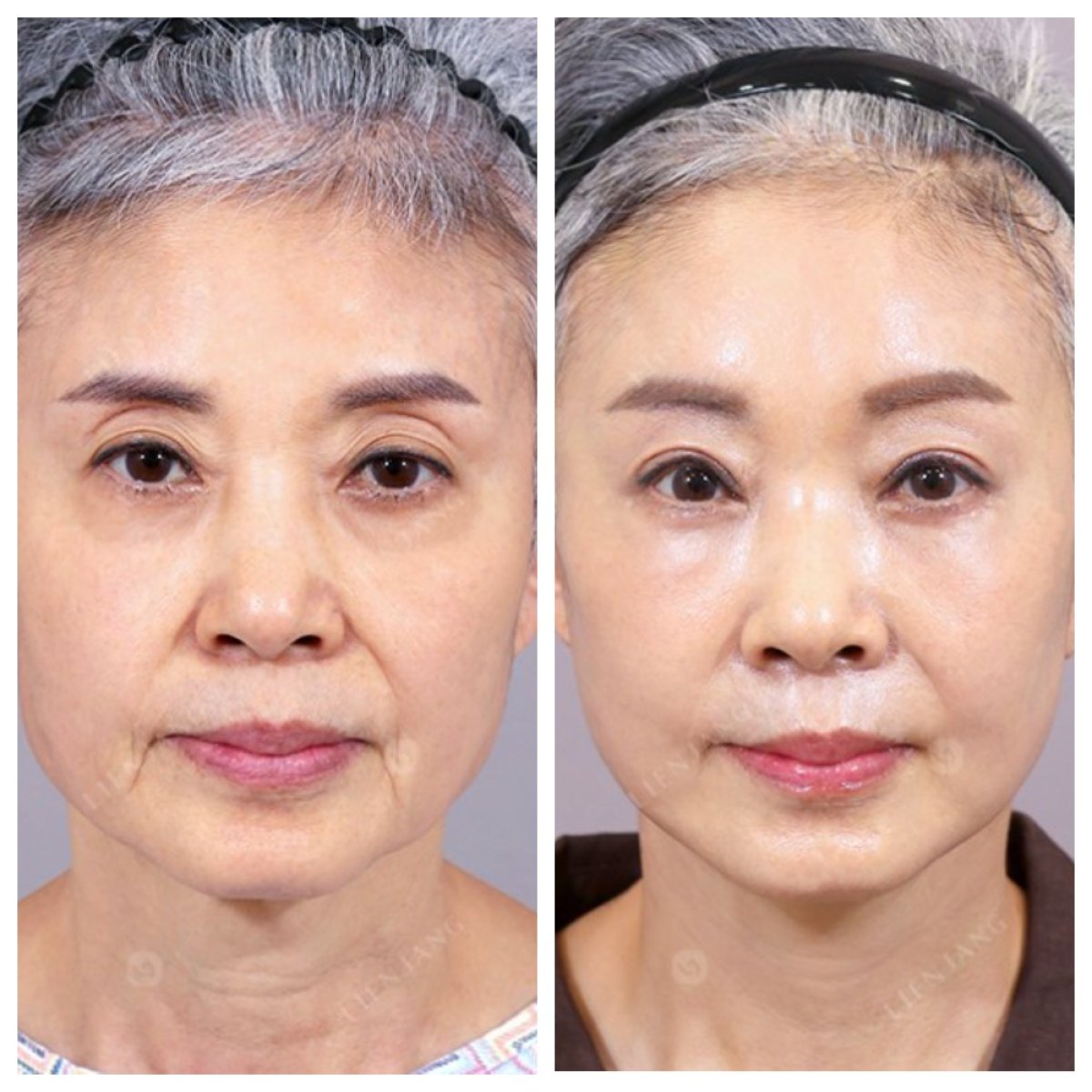Результаты до и после deep plane facelift – омоложение лица и подтяжка кожи