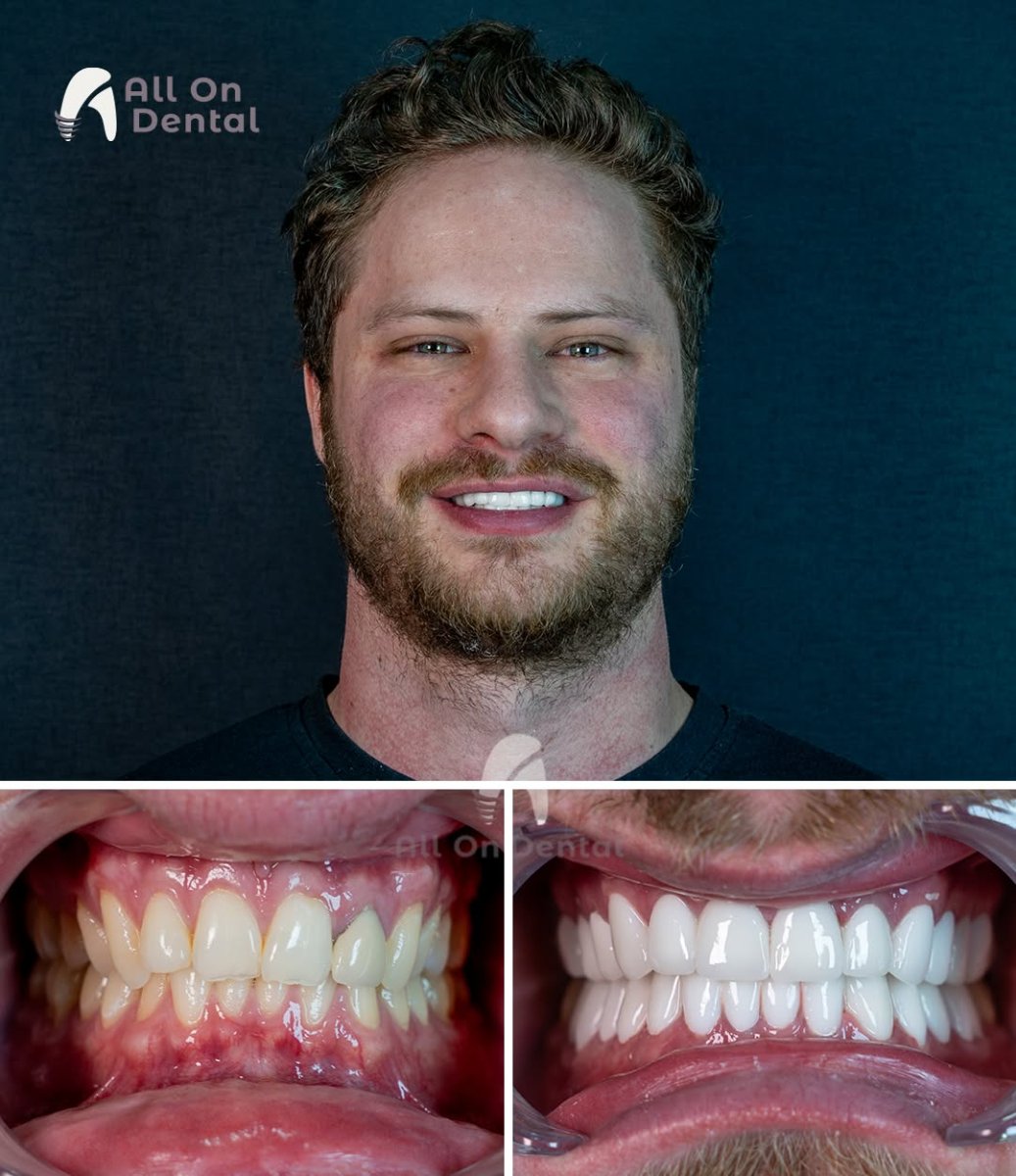 Результаты до и после установки коронок в All On Dental – улучшение эстетики улыбки