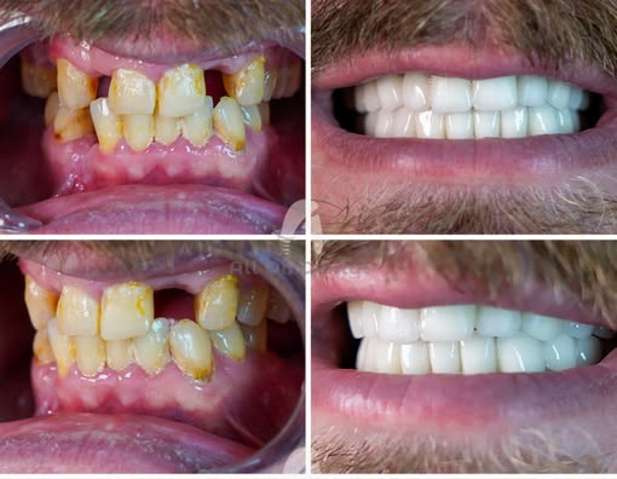 Before and after dental implant with crown results – restored smile and improved teeth alignment