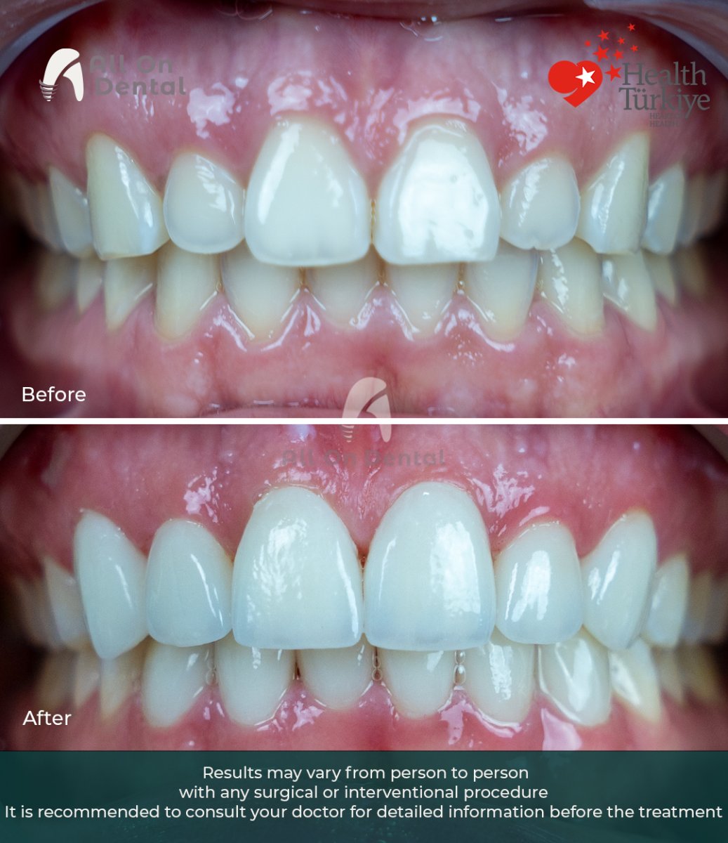 Resultado antes y después de carillas Emax en All On Dental – transformación de la sonrisa