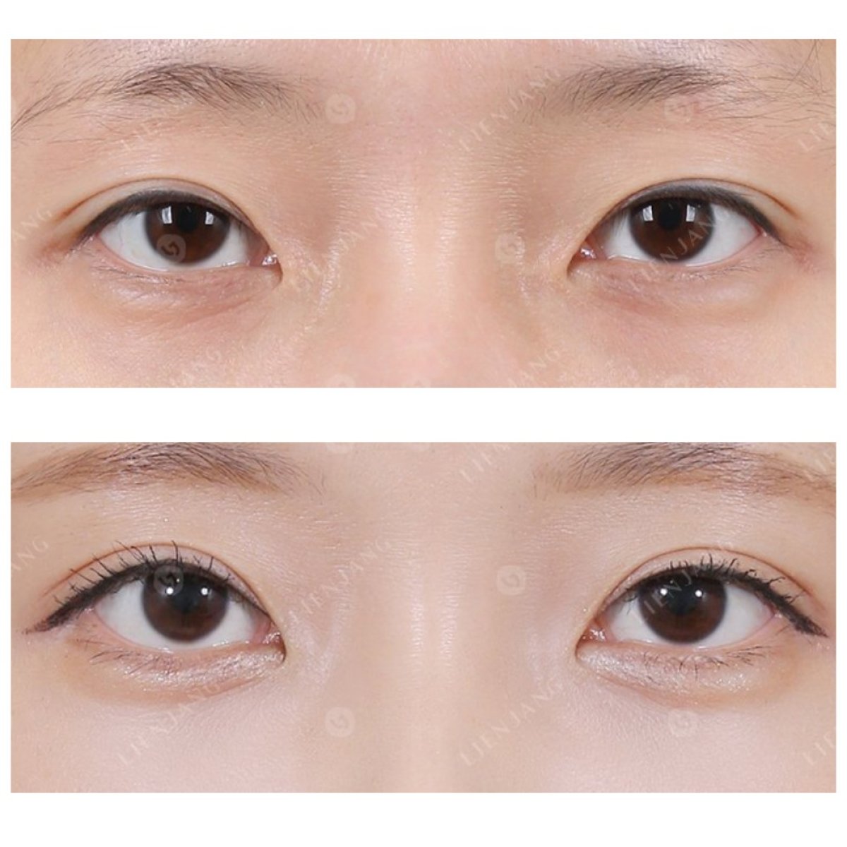 Before and after droopy eyelid surgery results, improved eye appearance and symmetry