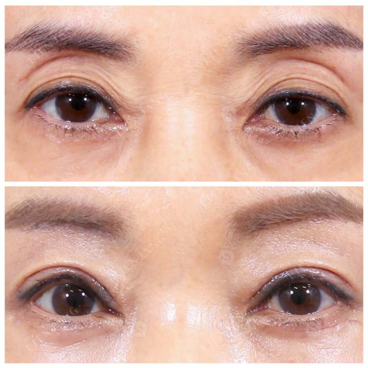 Resultados de blefaroplastia antes y después: corrección de párpados y mirada rejuvenecida