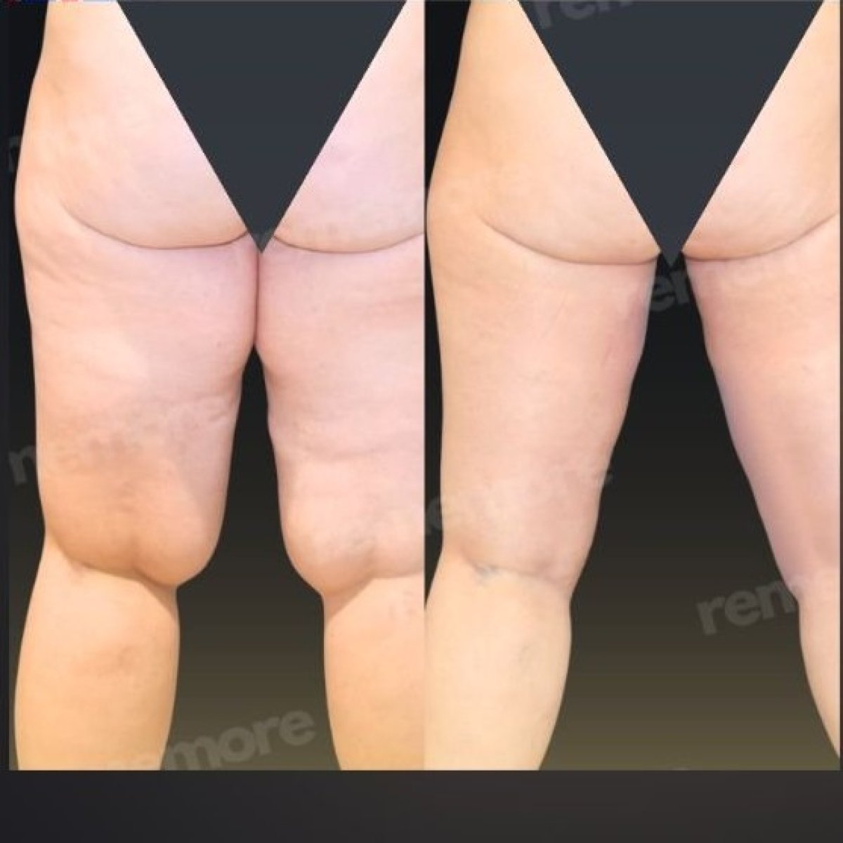 Before and after liposuction results at Memorial Göztepe Hospital, thigh contour improvement