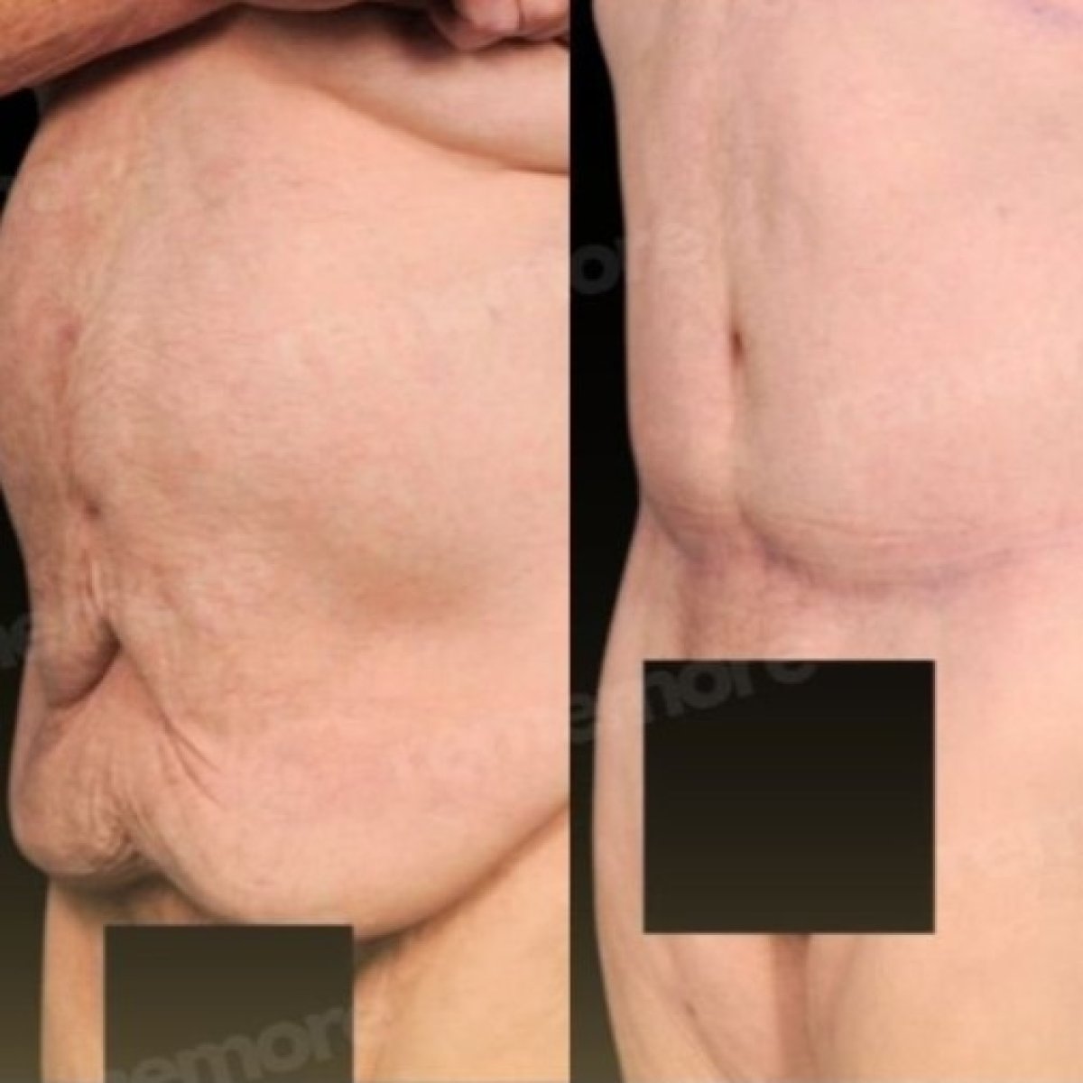 Resultados antes y después de lifting corporal inferior en Memorial Bahçelievler Hospital, mejor contorno