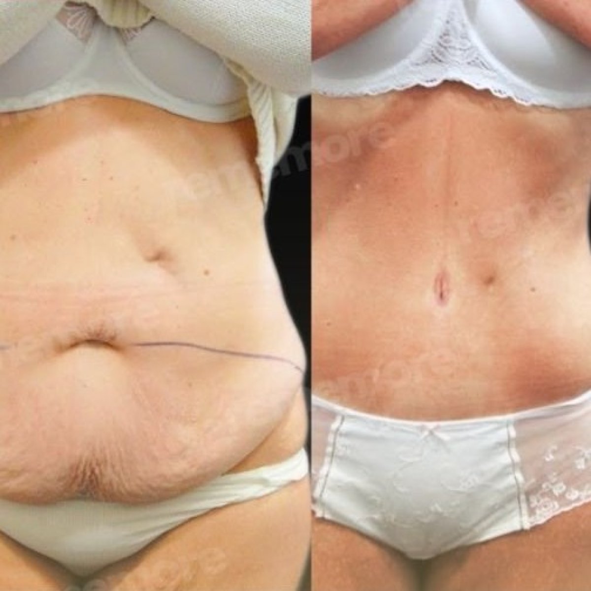 Resultados de lifting corporal inferior antes y después en Memorial Bahçelievler Hospital, abdomen