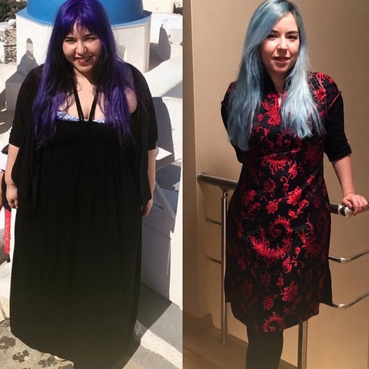 Before and after Roux-en-Y gastric bypass at Memorial Göztepe Hospital, visible weight loss result