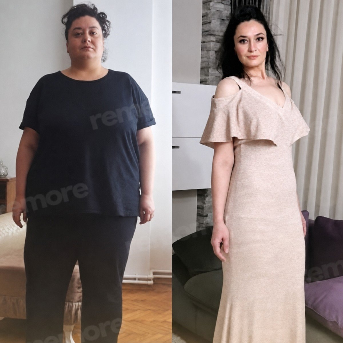 Before and after Roux-en-Y gastric bypass results at Memorial Göztepe Hospital, weight loss