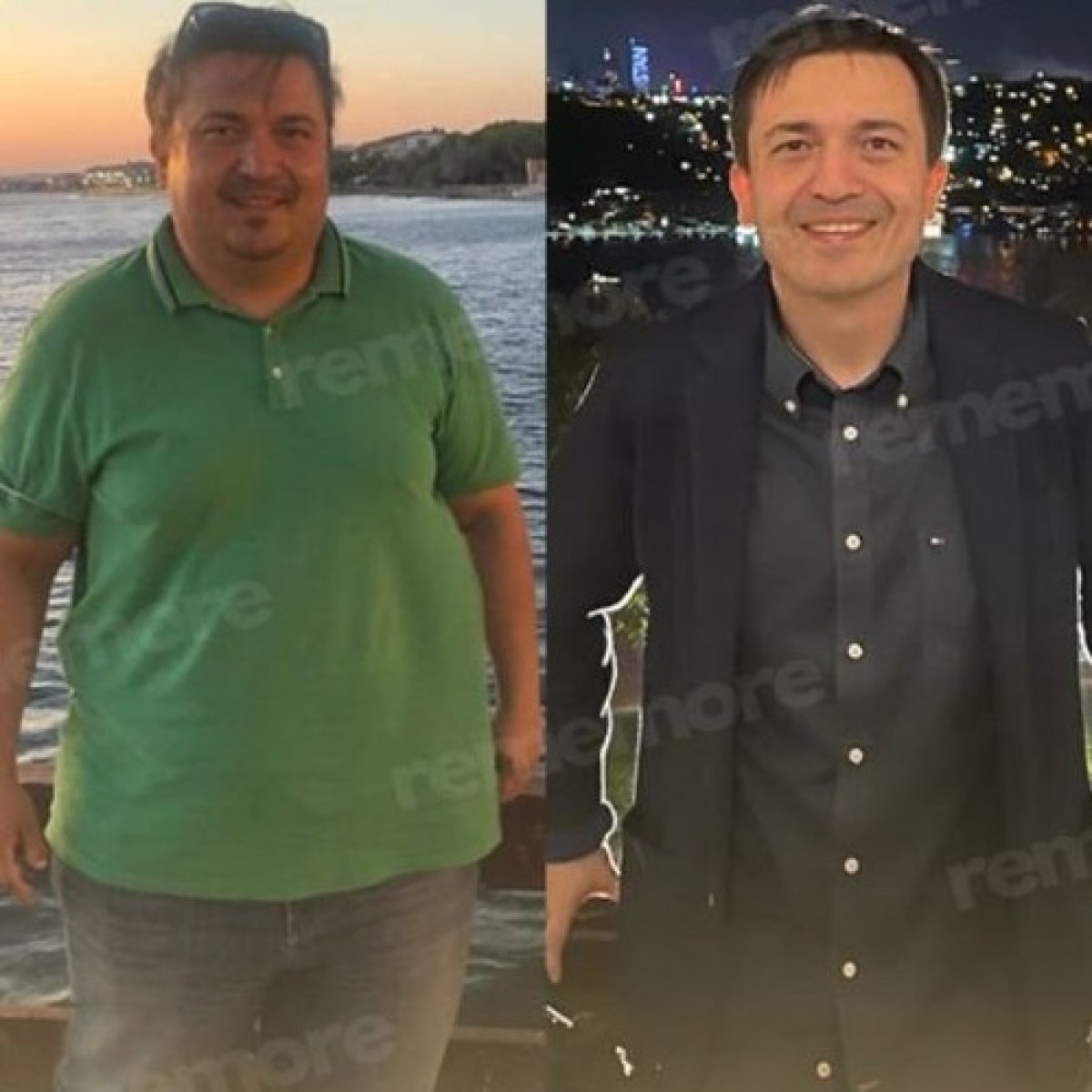 قبل وبعد تحويل مسار المعدة Roux-en-Y في مستشفى ميموريال غوزتيبي، نتيجة فقدان الوزن