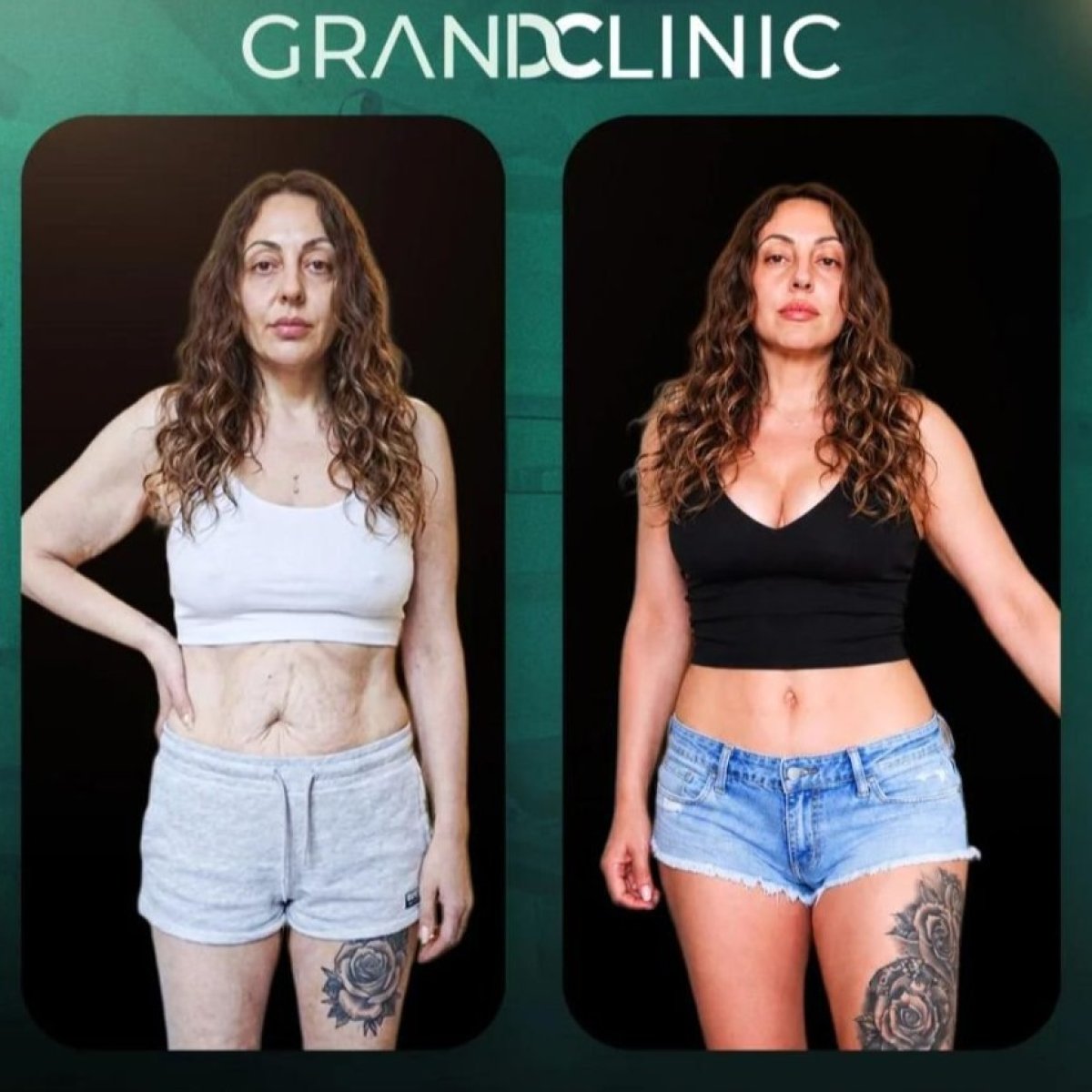 Before and after tummy tuck results at Grand Clinic – visible abdominal contour improvement
