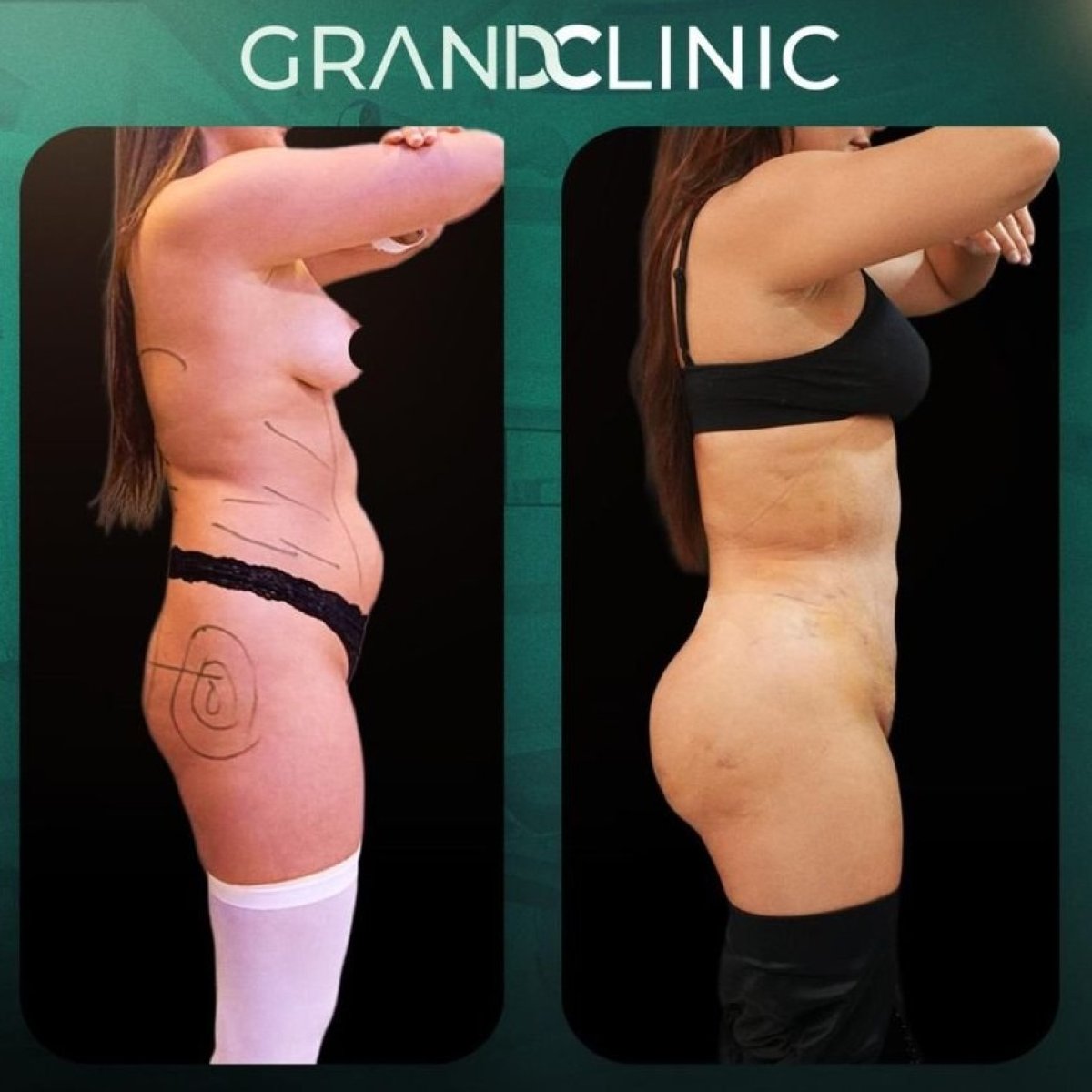 Результаты до и после абдоминопластики в Grand Clinic – улучшение контура живота