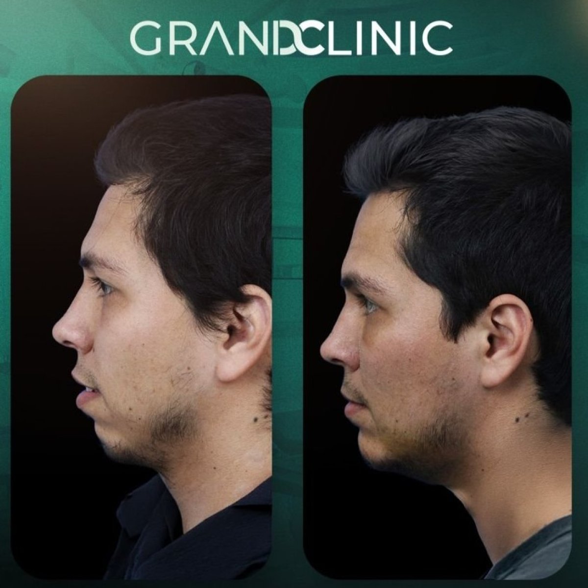 Before and after chin implant results at Grand Clinic, improved chin profile and contour