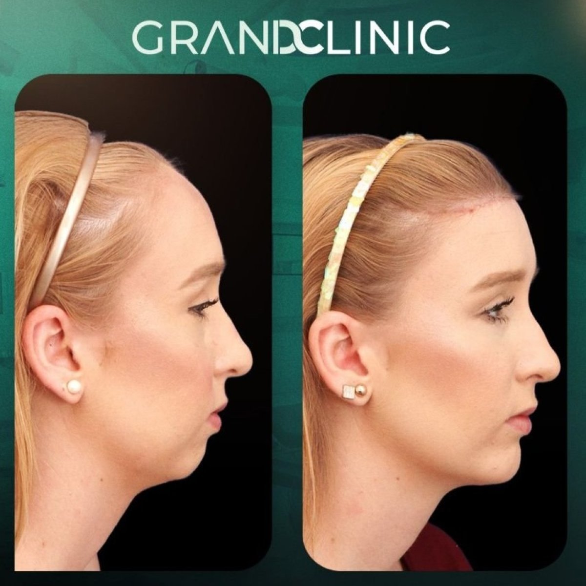Результаты до и после имплантации подбородка в Grand Clinic, улучшенный профиль подбородка