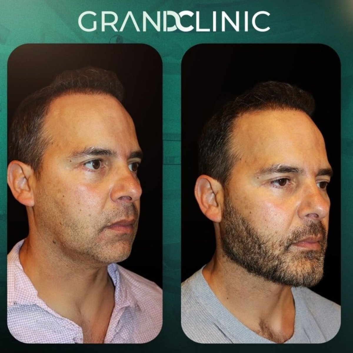 نتائج قبل وبعد زراعة الذقن في Grand Clinic، تحسين تحديد وكونتور الذقن