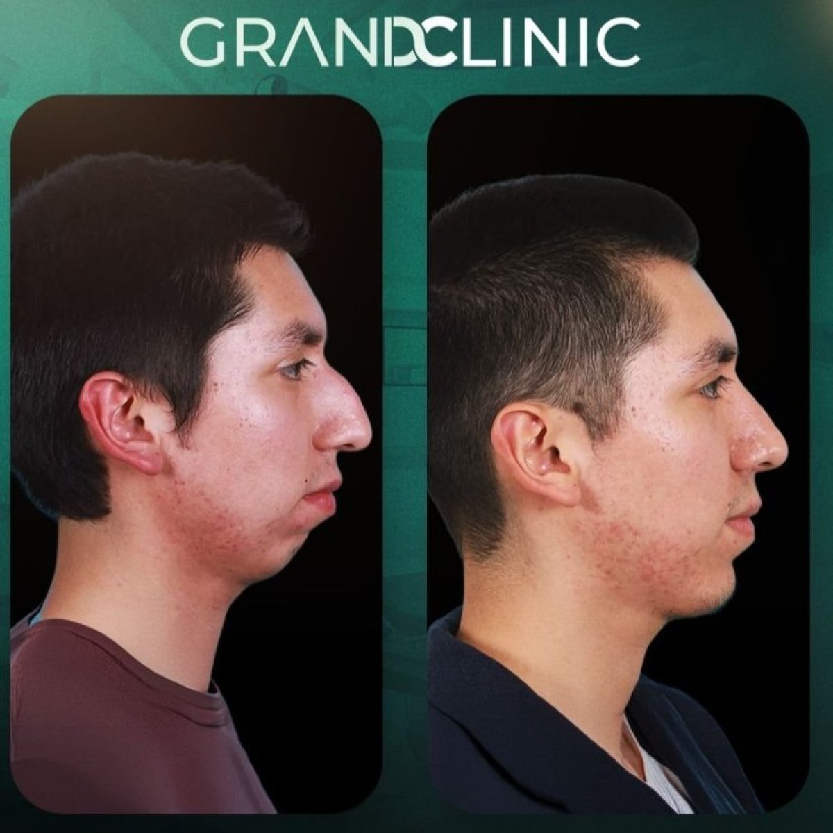 Before and after chin implant results at Grand Clinic, improved chin profile and contour