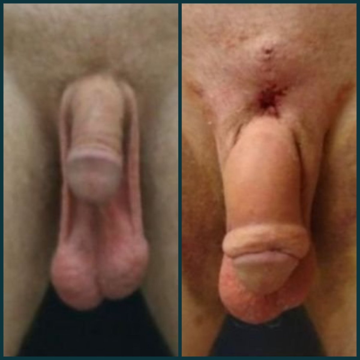 Before and after penile implant surgery results at Grand Clinic, improved function and appearance