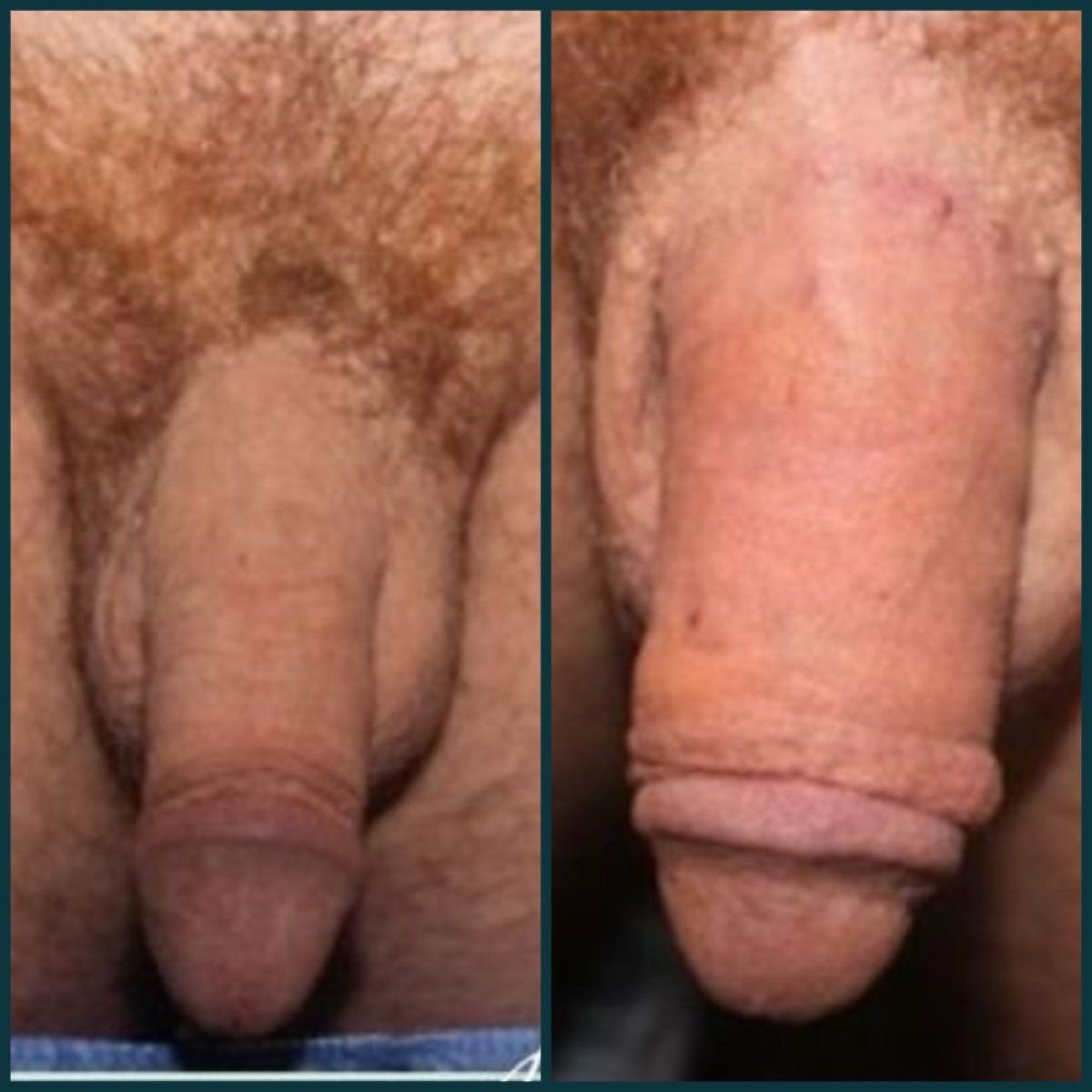 Before and after penile implant surgery results at Grand Clinic, improved shape and function