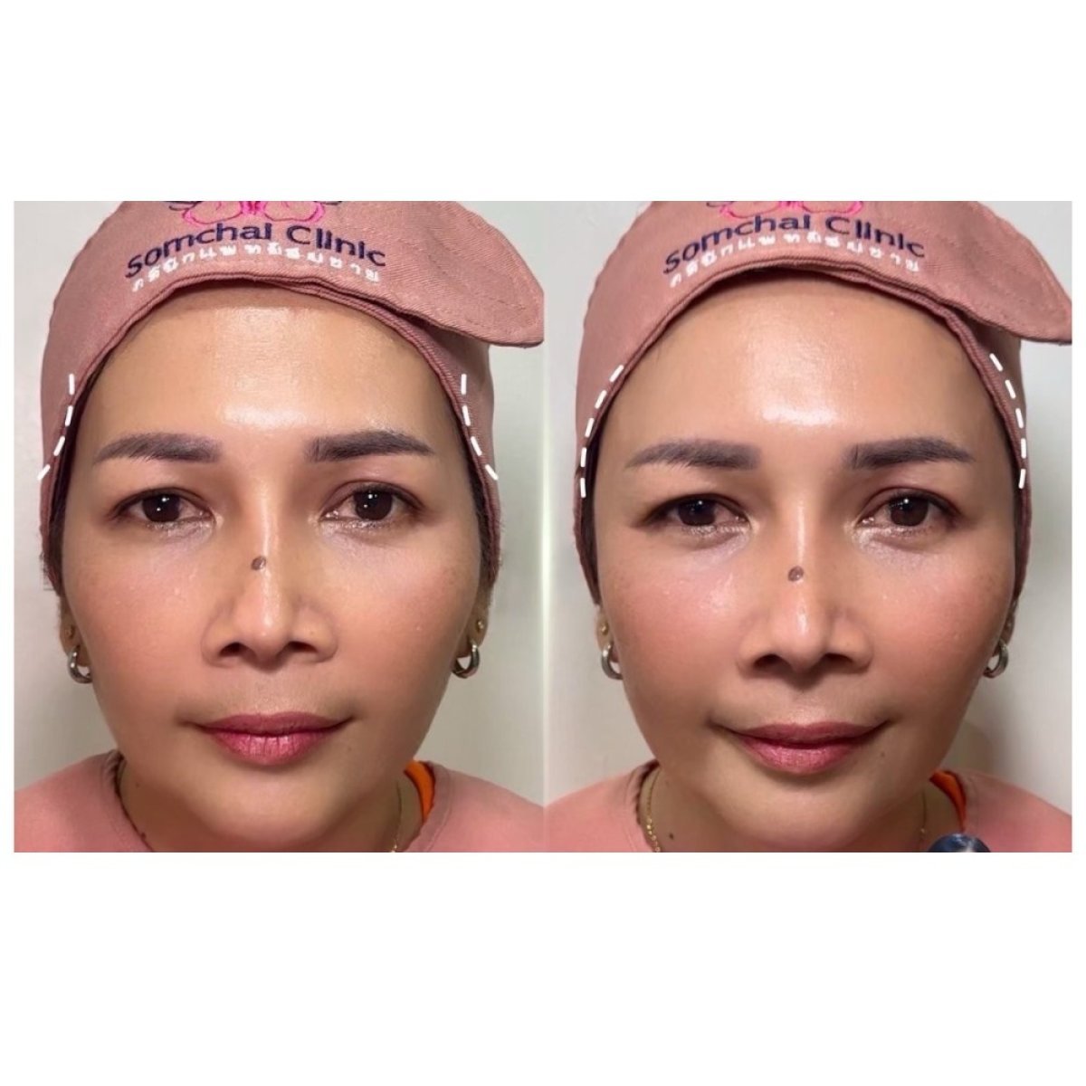 Before and after fillers injection result at Somchai Clinic, enhanced facial volume and contour