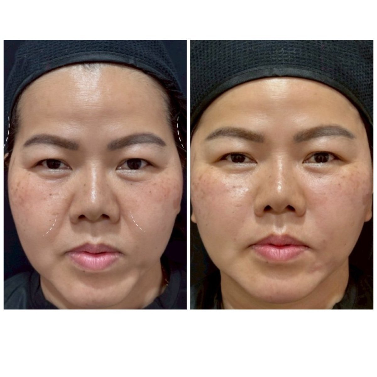 Before and after fillers injection result at Somchai Clinic, smoother nasolabial folds