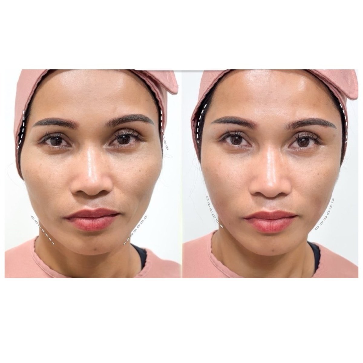 Resultados antes y después de rellenos faciales en Somchai Clinic, contorno facial visible