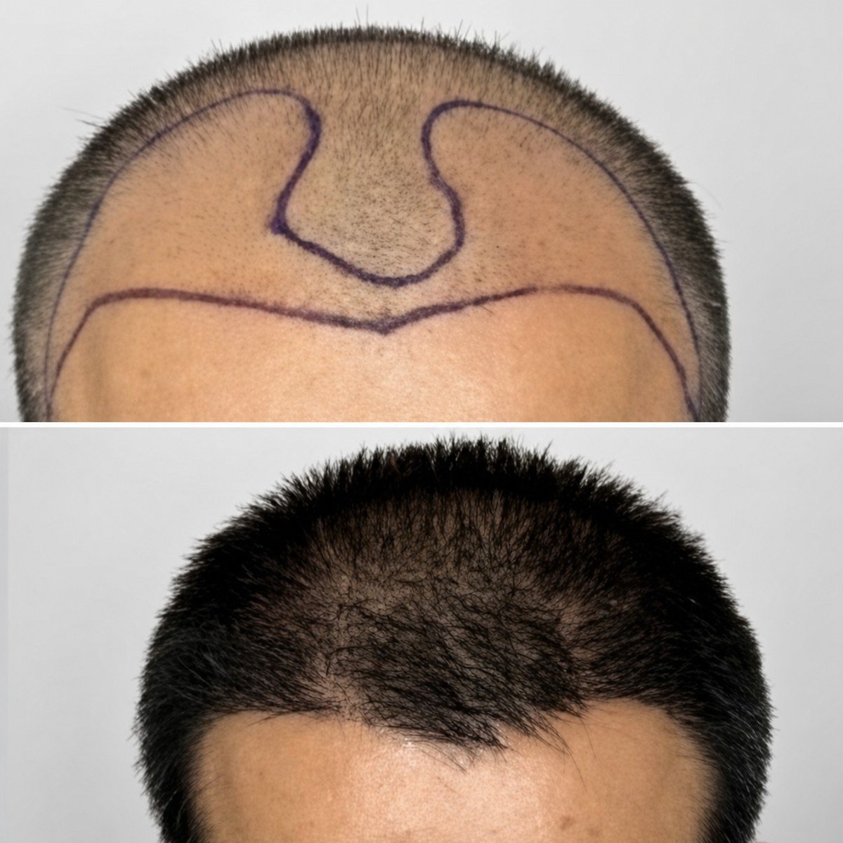 Before and after hair transplant results at Somchai Clinic, restored hairline and density