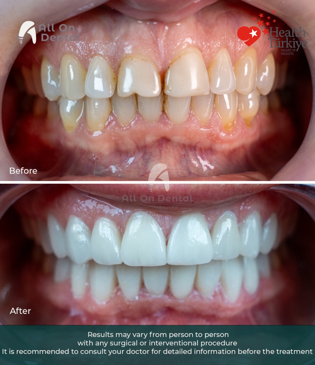 نتائج زراعة الأسنان قبل وبعد في عيادة All On Dental – تحسين جمالية الابتسامة