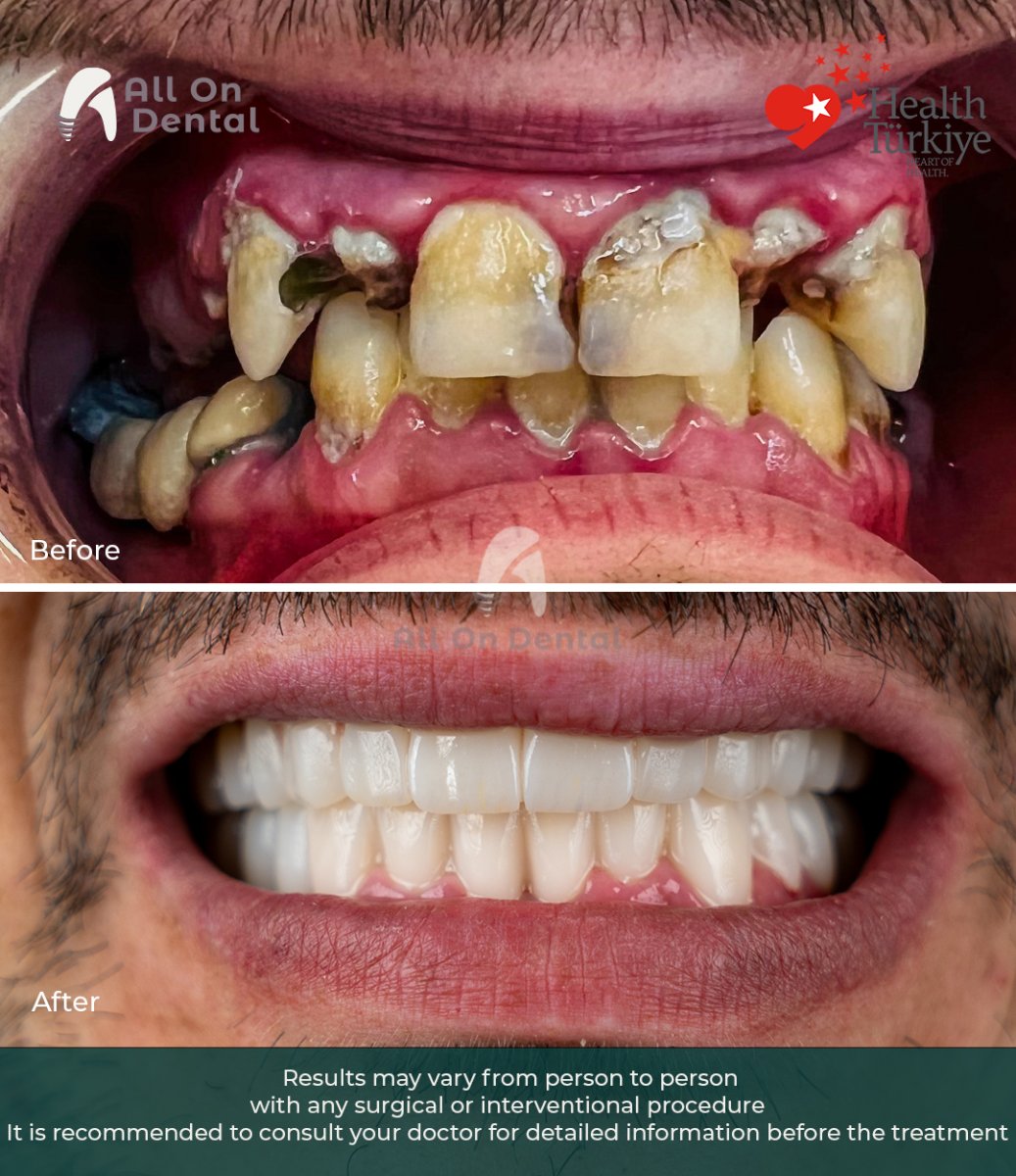 Before and after dental implant results at All On Dental clinic – restored smile transformation