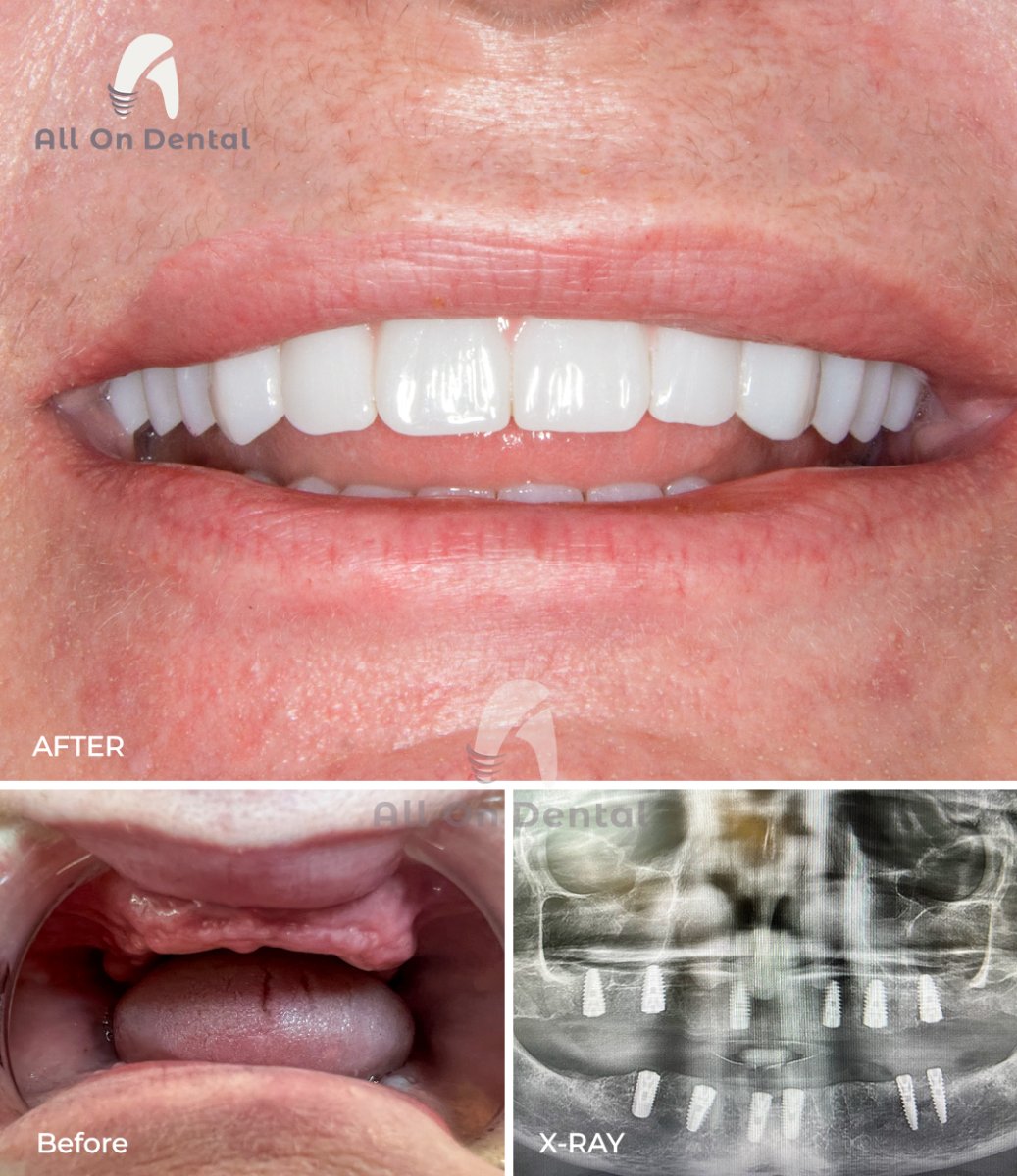 Результаты до и после имплантации зубов в All On Dental – восстановление улыбки