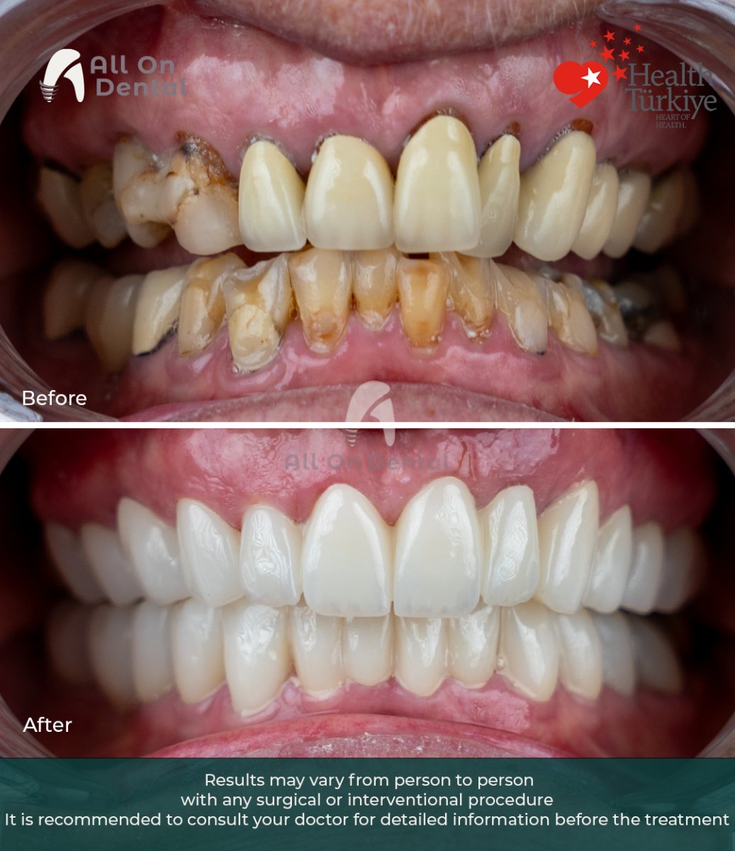 До и после установки виниров в All On Dental – преображение улыбки с естественным результатом