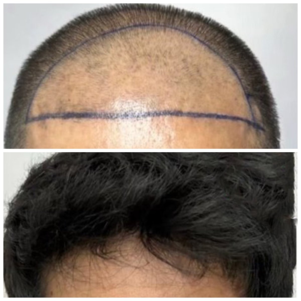 Before and after hair transplant result at Somchai Clinic – restored natural hairline
