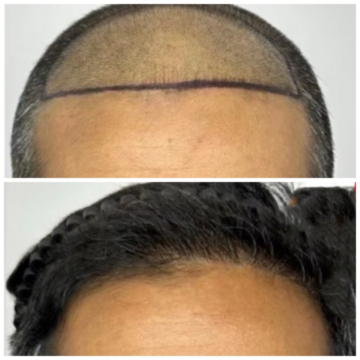 نتيجة زراعة الشعر قبل وبعد في عيادة سومشاي – استعادة خط الشعر الطبيعي