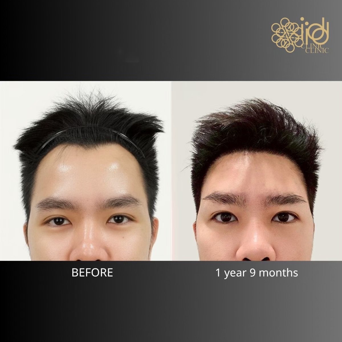 Before and after hair transplant results at ID Clinic Bangkok, improved hairline after 1 year 9 months