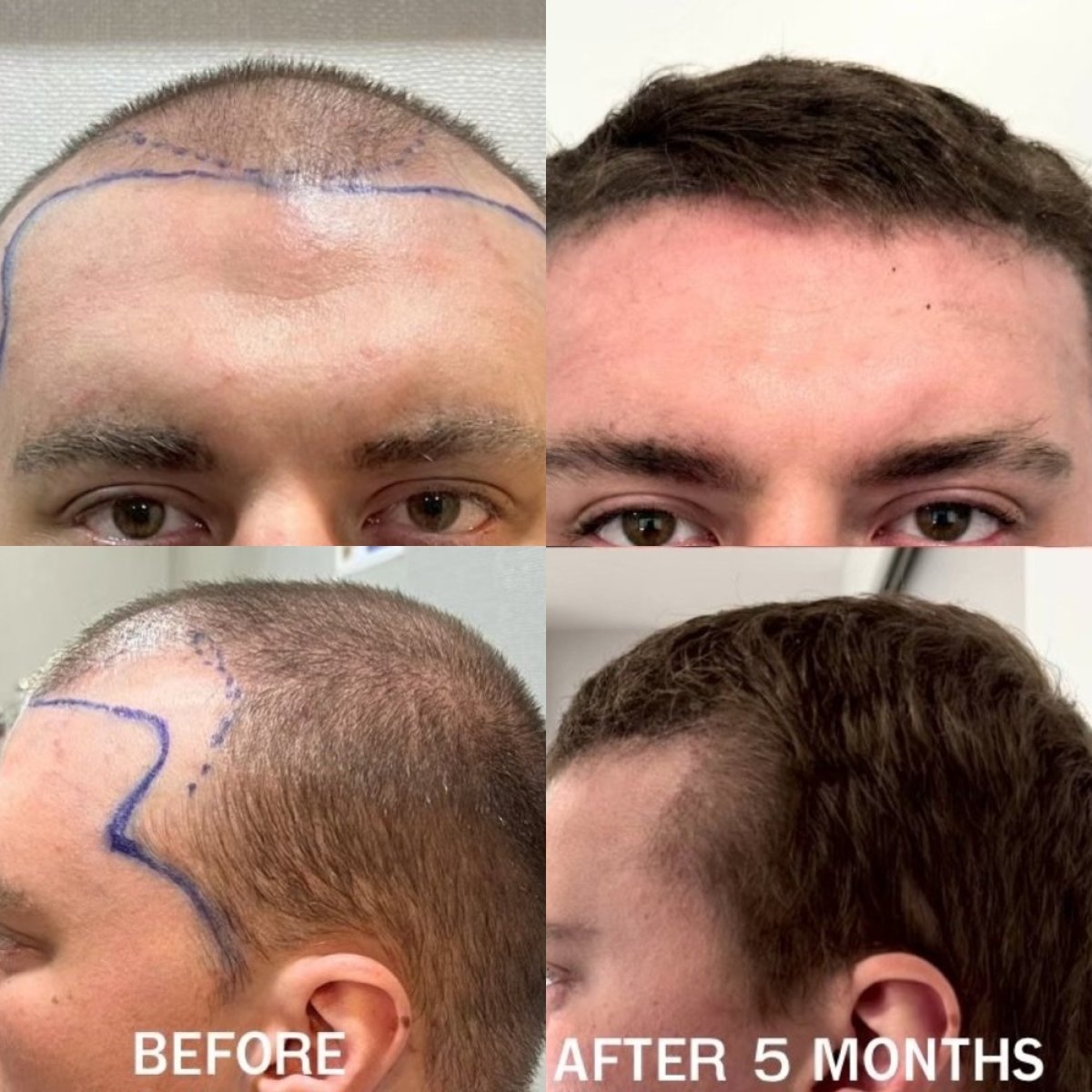 Before and after hair transplant results at ID Clinic Bangkok, fuller hairline after 5 months