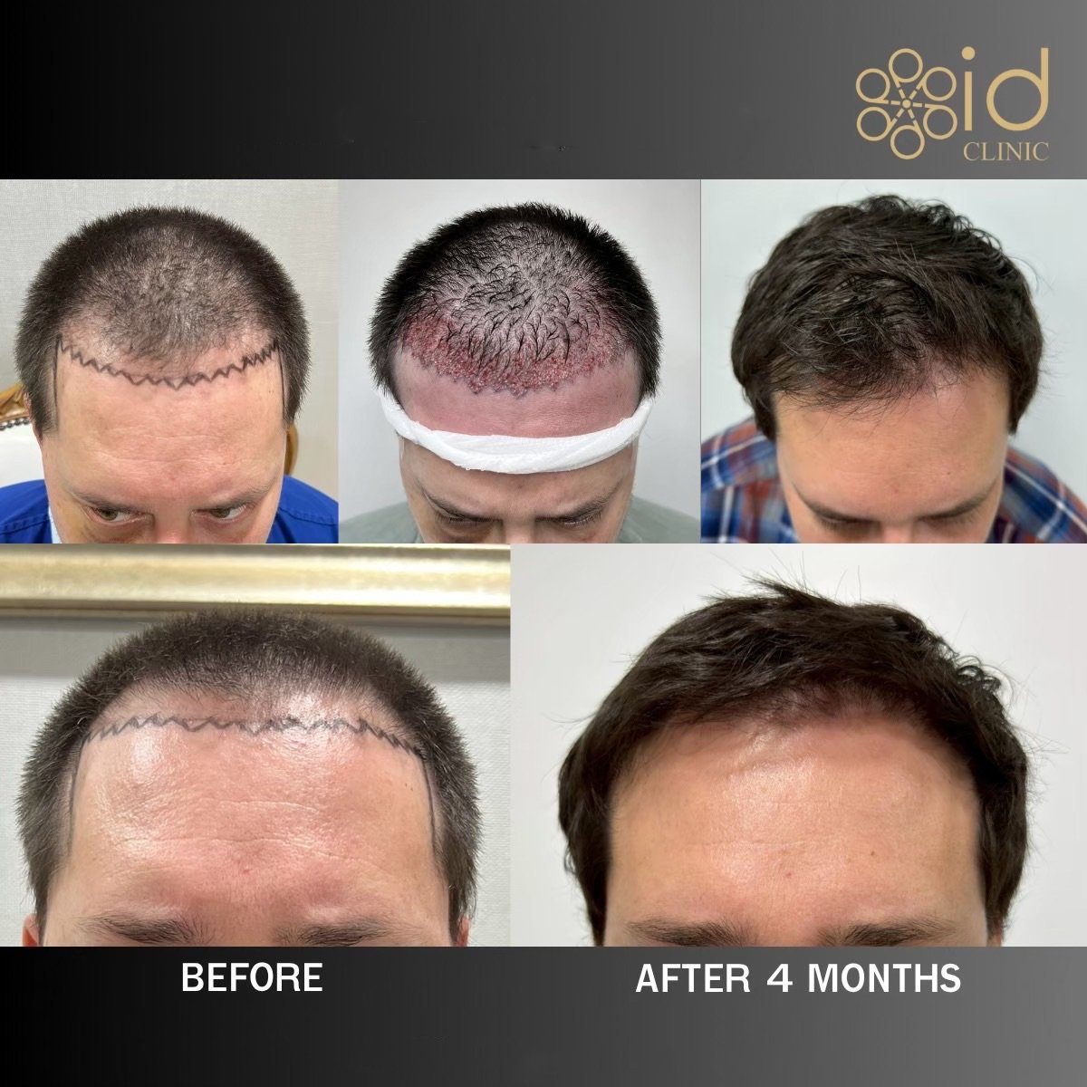 Before and after hair transplant results at ID Clinic Bangkok, visible hairline improvement in 4 months