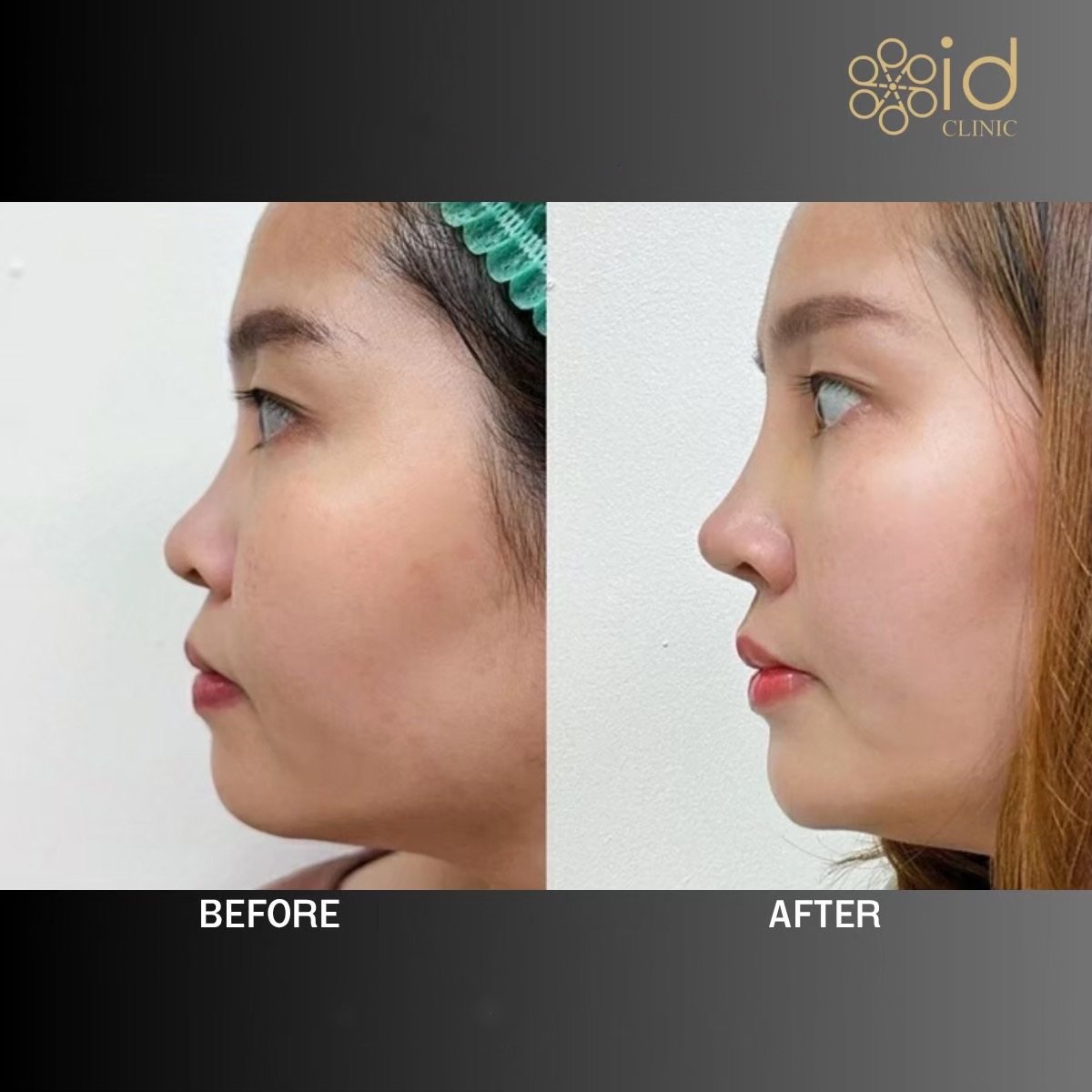 Before and after rhinoplasty results at ID Clinic Bangkok, nose reshaping for improved profile