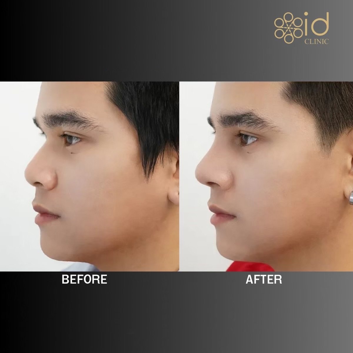Before and after rhinoplasty results at ID Clinic Bangkok, improved nose shape and profile