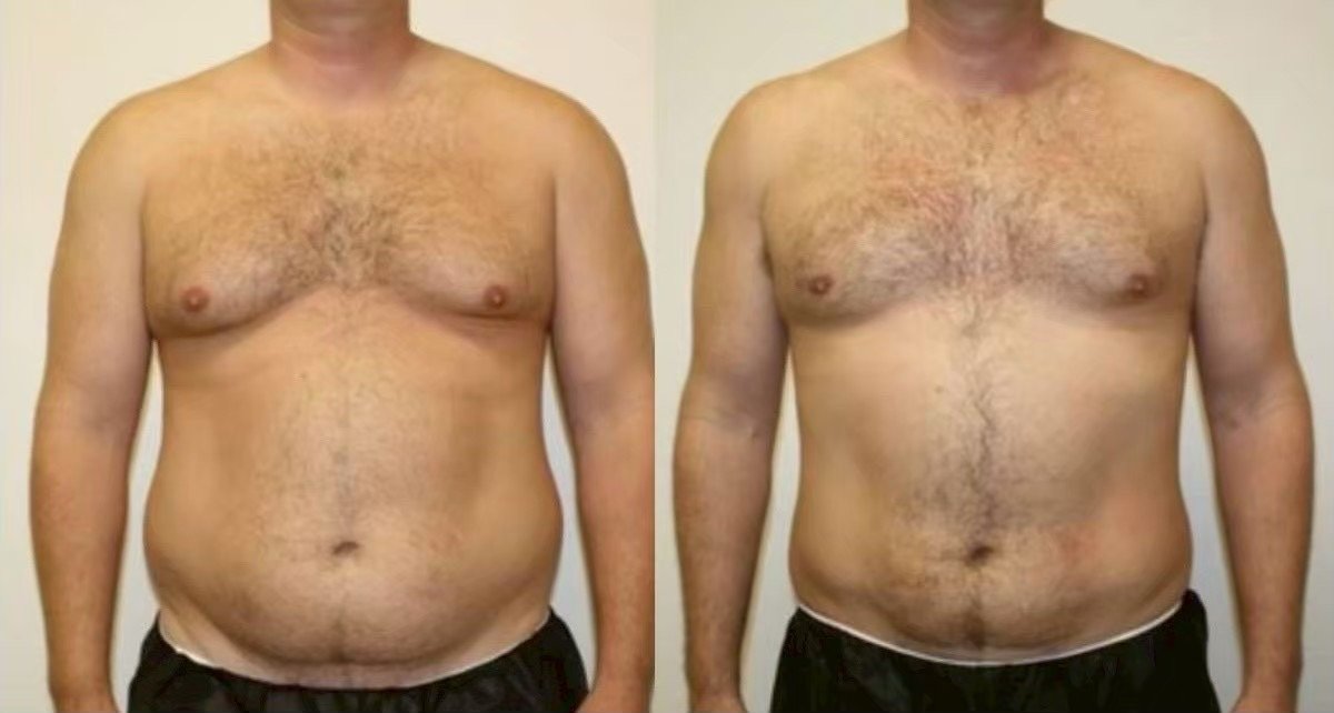 Before and after abdominal liposuction result at Somchai Clinic, visible fat reduction in men